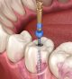 How Much is a Root Canal Procedure?