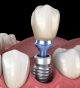 What is the Average Cost of Dental Implants?