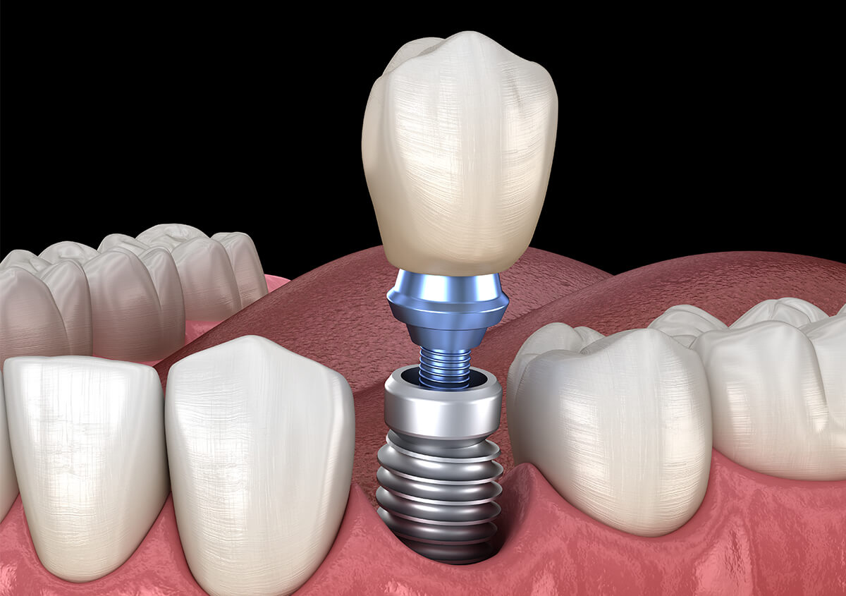 What is the Average Cost of Dental Implants in Alberta Area