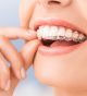 Is Invisalign the Right Orthodontic Treatment for You?