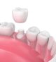 Cracked Front Teeth? Make Them Whole Again with Dental Crowns