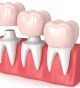 What is the process of getting a dental crown on your tooth?
