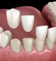 What is the process of getting a dental crown on your tooth?